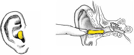 'Can earplugs reach the eardrum and cause damage to the eardrum?'
One picture with outer Ear with earplug. Another picture with cross section of Inner, middle and outer ear with ear plug.
